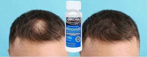 thuoc-minoxidil-5-huong-dan-su-dung-de-co-hieu-qua-tot-nhat2